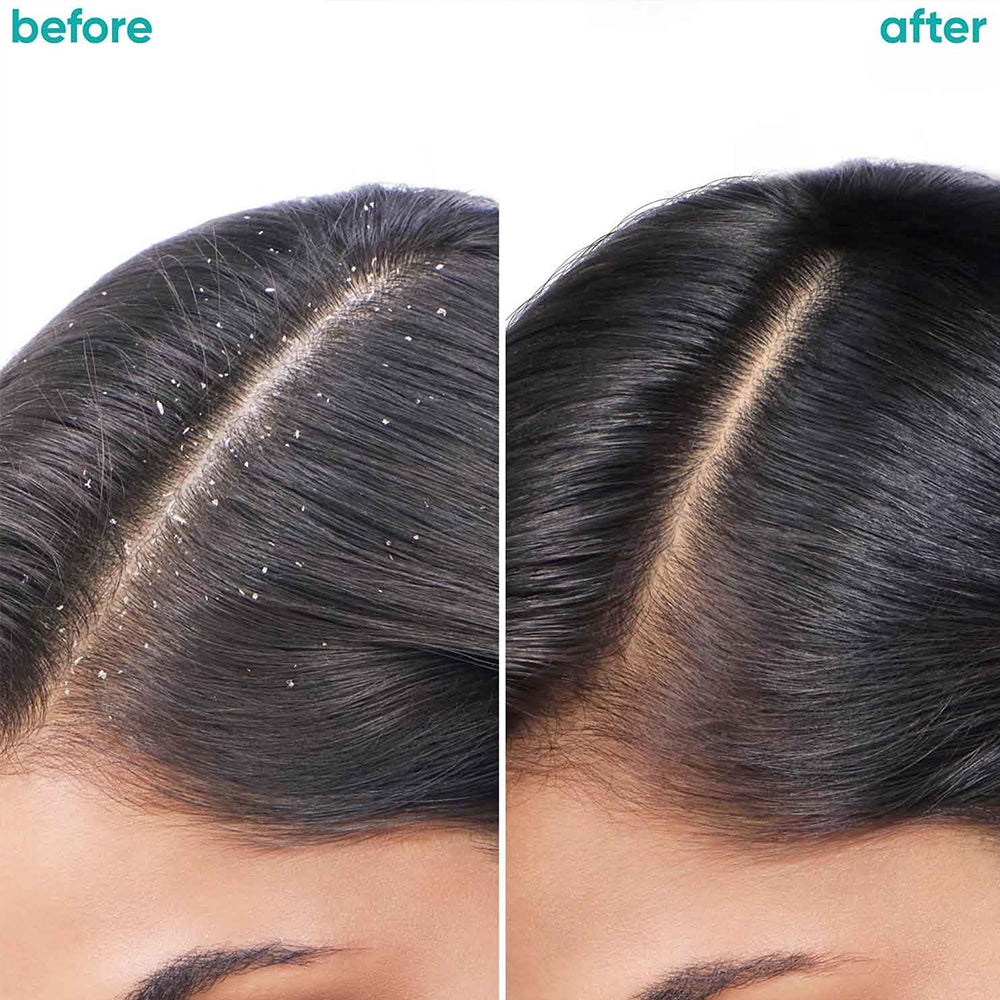 MATRIX BIO ADV SCALPPURE DANDRUFF SHAMPOO 200MLD .