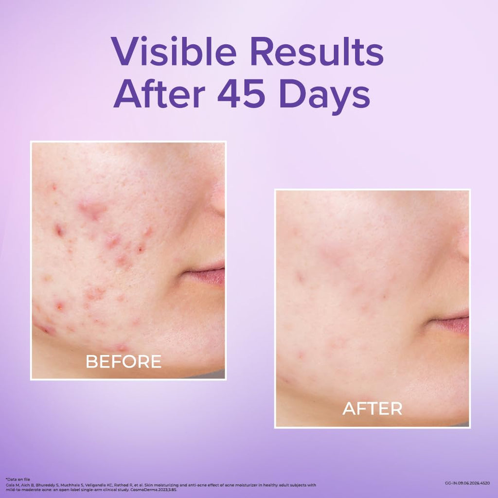 Venusia Acne Control Moisturizer 75g