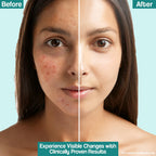 Venusia Acne Control Moisturizer 75g