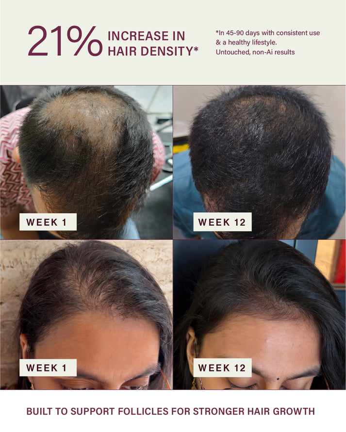&Done Hairfall Rescue Kit Shampoo, Conditioner & Serum