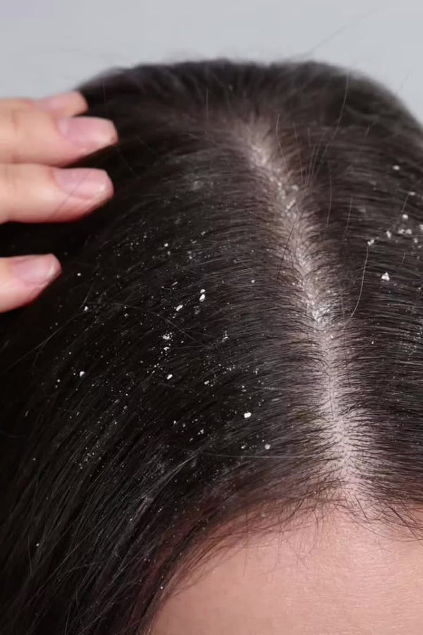 Dandruff